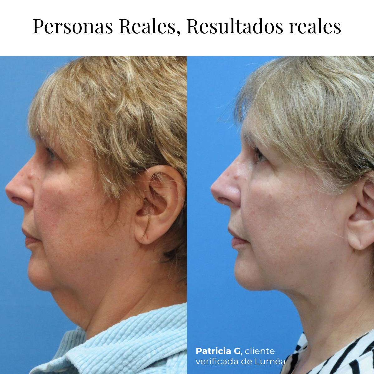 Lifting Neck Cream